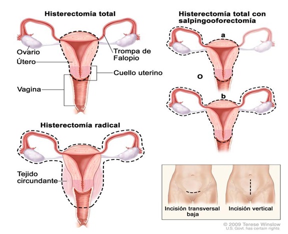 Quirurgica pdf total tecnica histerectomia